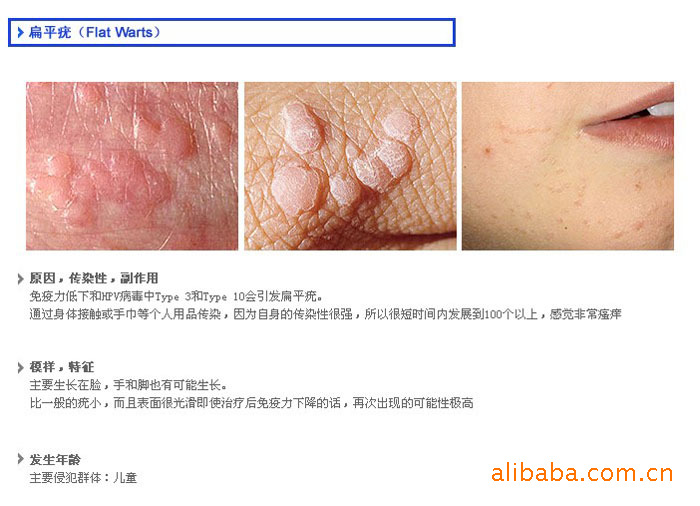 皮肤病水疣扁平疣产生原因与解决办法 韩国天然米莱尔