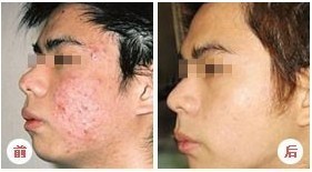 光动力祛痘对比图1