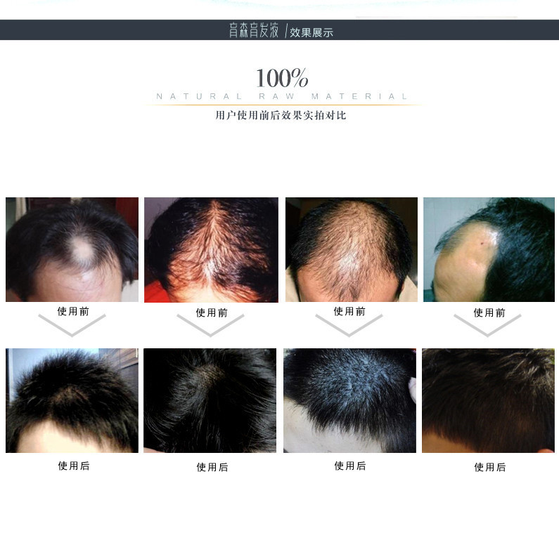 【专治脱发解决各类脱发问题:新产品上市 育森