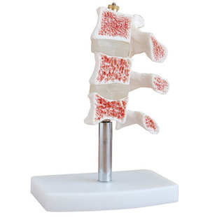 教学仪器-骨质疏松模型(脊椎典型病变模型)-教
