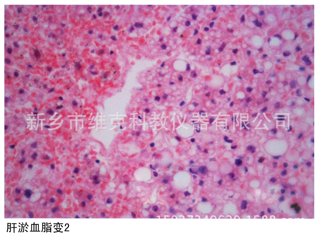 慢性肝淤血切片生物切片 高等学校病理图片 血液循环障碍