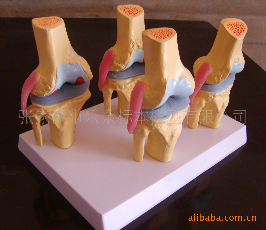 供应膝关节病理模型,教学.医学.解剖模型.促销产品