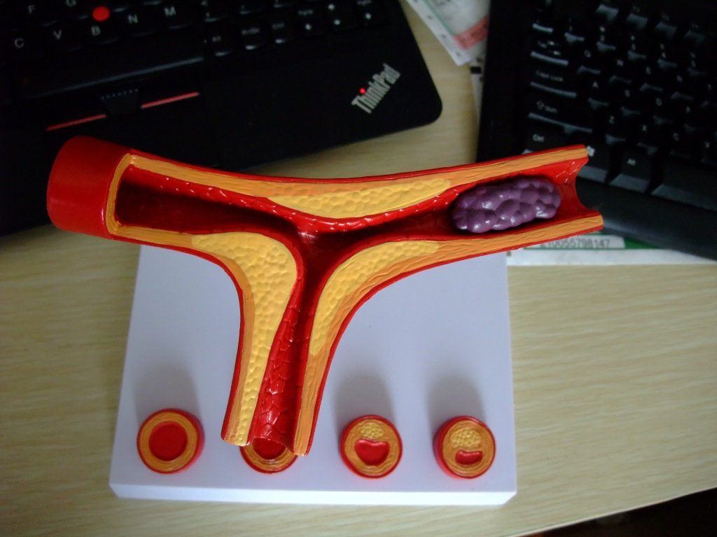 供应动脉硬化模型(带血栓) 血栓病变模型