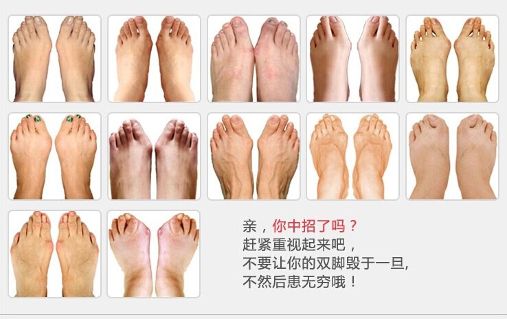 双环拇外翻日夜用大拇指外翻